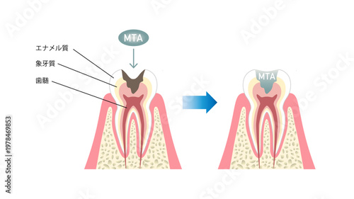 MTAを虫歯に入れる