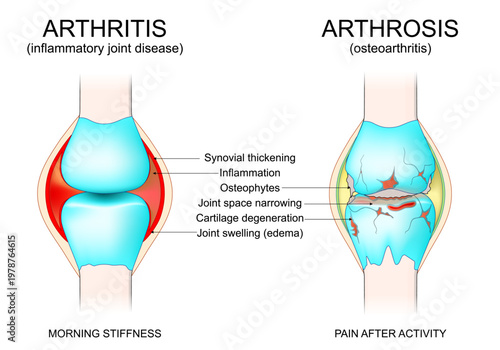 Arthritis vs Arthrosis. Symptoms of Inflammatory joint disease and Osteoarthritis.