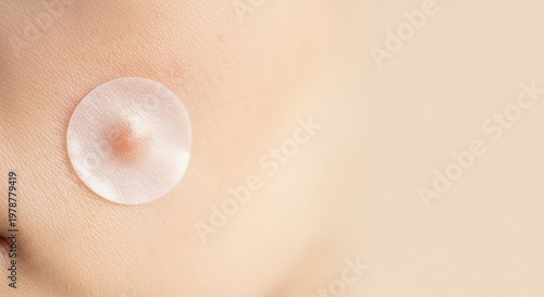 Close-up of a Pimple Patch on Skin for Acne Treatment.