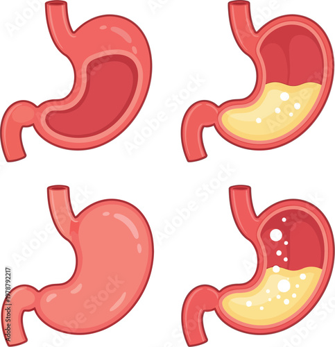 Stomach anatomy diagrams illustrate healthy and acidic conditions for medical reference.