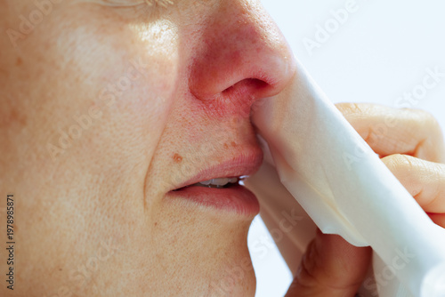 Photos Side profile view of a person using a white tissue to wipe a red and irritated nose, illustrating relief from cold, flu, or allergic rhinitis symptoms