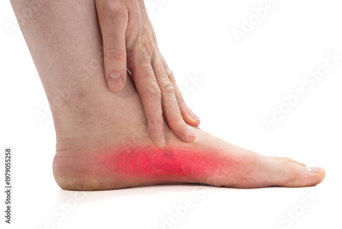 Quadro em tela Close-up of a foot with flat arch showing red inflamed area along the sole near the heel, hand touching the midfoot on a white background