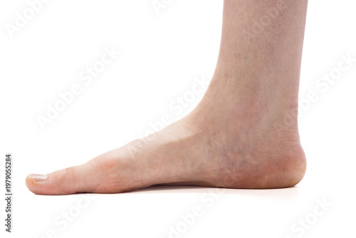 Canvastavla Close-up of a human foot with a low medial arch resting on a white background, illustrating flat feet and related ankle/plantar conditions