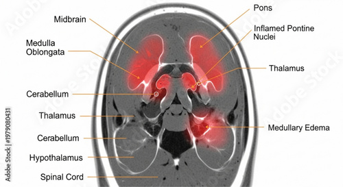Medical illustration of a human brain scan showing inflamed pontine nuclei and medullary edema in cross section
