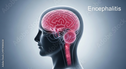 Clinical illustration of encephalitis showing inflammation of the brain and spinal cord in human profile.