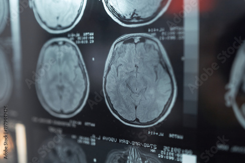 Принти на полотні Close up of brain MRI scans displaying diagnostic imaging for neurological examination and clinical analysis