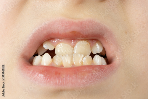 Wallpaper Mural Child with crowded teeth. Crooked permanent and baby teeth in a 8 year old child mouth. Torontodigital.ca