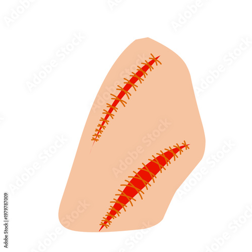 Vector illustration of a wound stitch. Flat design of a stitched wound. Illustration of a wound stitch on the skin