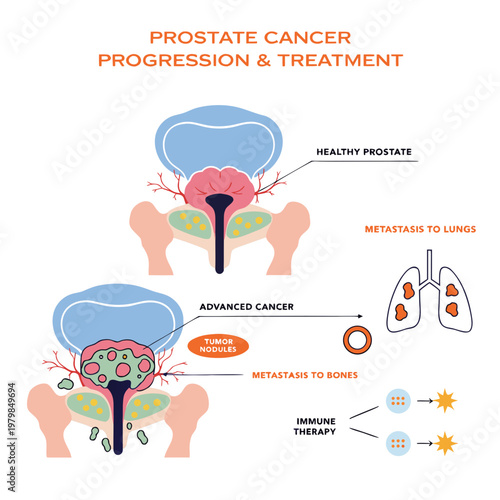 Prostate cancer progression and treatment medical infographic