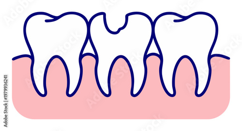 Tooth Decay and Cavity in Gum, Dental Caries Progression on Teeth