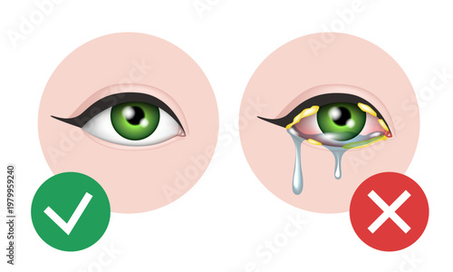 A healthy eye and an eye with bacterial conjunctivitis. Vector 3D illustration.