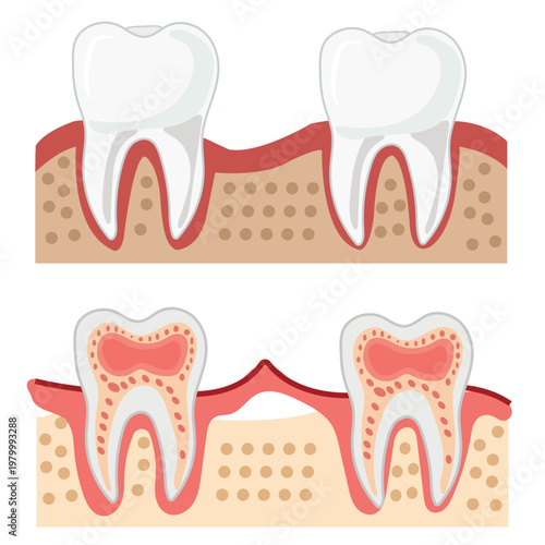 Tooth decay stages vector healthy and cavity dental