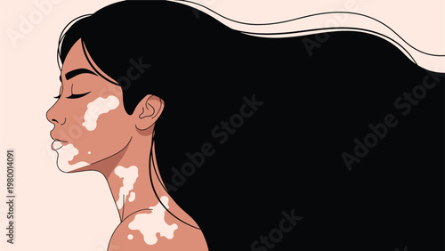 Side profile of a woman with long flowing black hair and vitiligo skin condition celebrating natural beauty and diversity.
