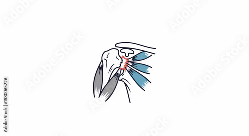 Medical illustration of painful shoulder joint with inflamed rotator cuff