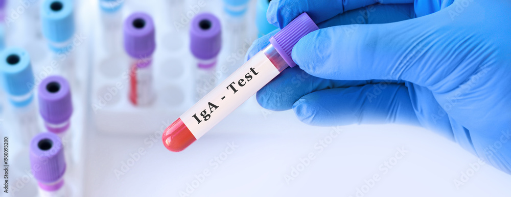 Obraz premium Doctor holding IgA blood test tube explaining immunoglobulin A level assessment, mucosal immune response evaluation and diagnosis of immune system disorders in clinical laboratory diagnostics