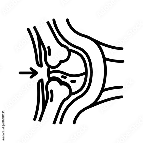Illustration of a knee joint showing signs of wear and tear on the cartilage