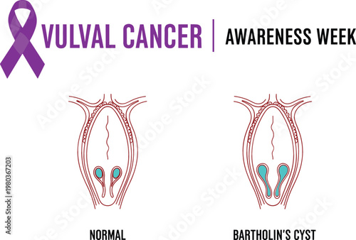 Vulval Cancer Awareness Week Infographic Featuring Purple Ribbon Symbol and Comparative Anatomy Diagrams of Normal Glands Versus Bartholin's Cyst for Medical Educational Materials