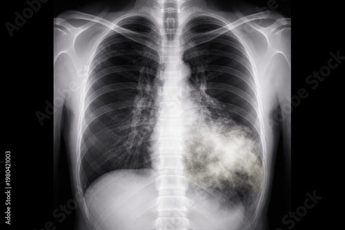 Chest X-ray showing lobar p...