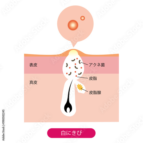 白ニキビ