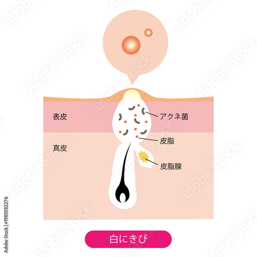 白ニキビ