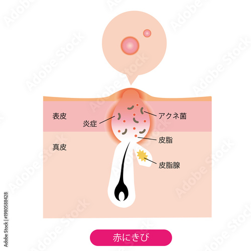 赤ニキビ
