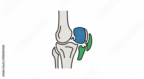 Stylized diagram showing knee joint bones with cartilage