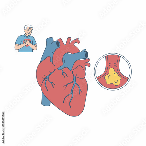 Human Heart Illustration with Senior Man Chest Pain and Blocked Artery