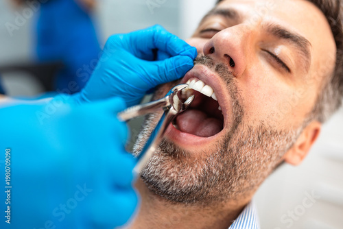 Fotografi Tooth extraction procedure