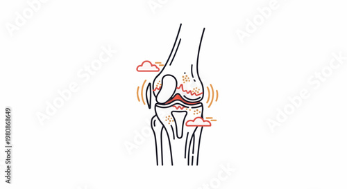 Anatomical illustration of a distressed knee joint, showing bone erosion and inflammation