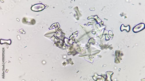 Calcium oxalate monohydrate crystals and dihydrate in urine under microscope.