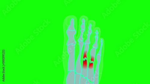 Broken foot bones x ray, roentgen sample green screen animation. Top foot xray big toe symptom structure.  Feet anatomy. Medical video