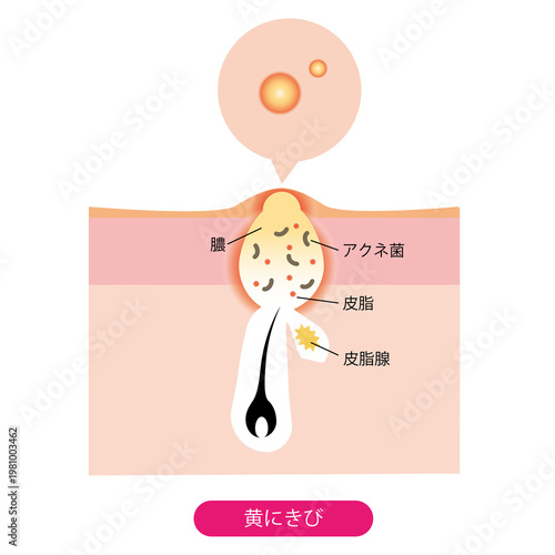 黄にきび