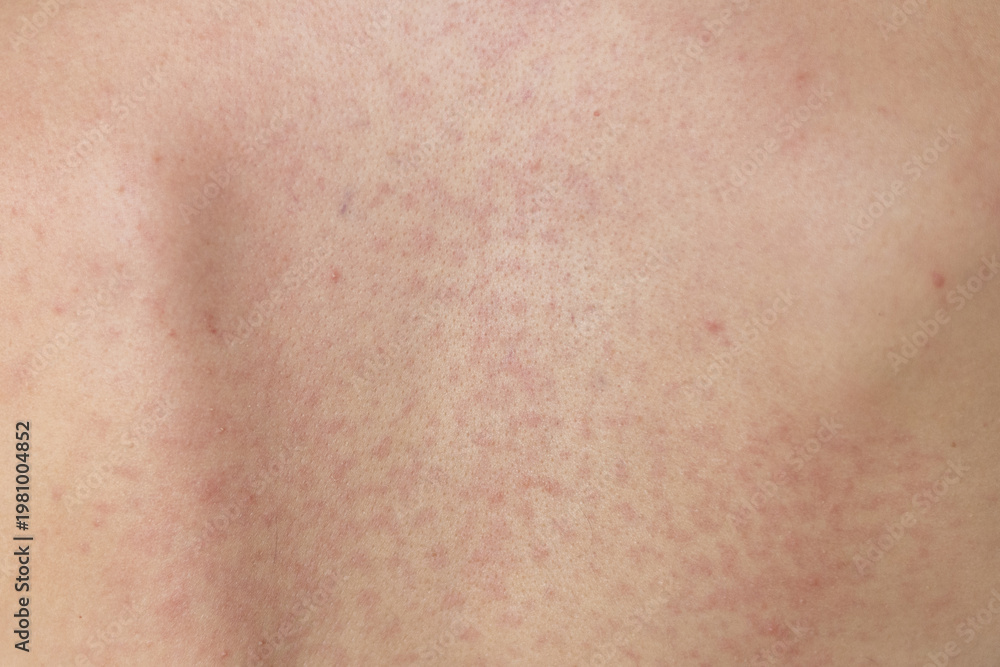 Naklejka premium Skin condition shows spots from possible irritation or allergic reaction on human skin in a close-up shot taken indoors