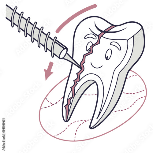Cracked tooth with drill - dental cavity treatment illustration, pain relief