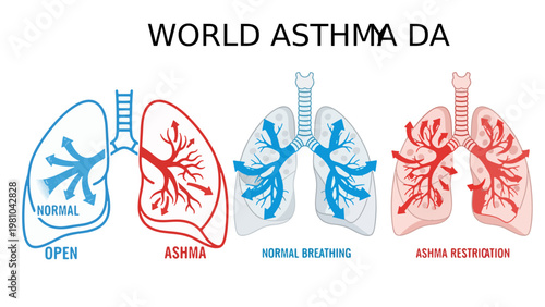 Medical Infographic Comparing Normal Lung Airflow to Asthmatic Bronchial Restriction in isolate trasperent Background for World Astma Day Designs