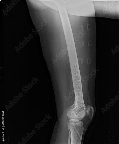 Fotografie Orthopedic X-ray of lower limb featuring femur, knee, and hip joints in grayscale diagnostic imaging