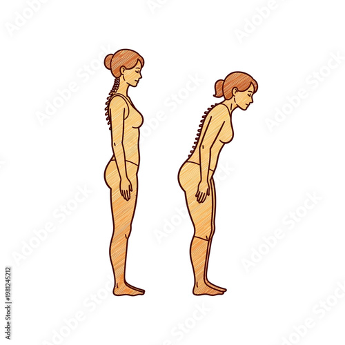 Illustration comparing good posture with a healthy spine to poor posture showing kyphosis or a hunched back in a female figure.