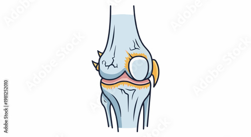 Cartoon depiction of a damaged human knee joint with inflammation and bone spurs