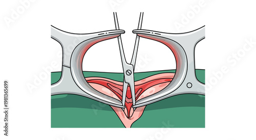 Vector Illustration of a Surgical Retractor in Action, Medical Procedure Representation, Surgical Instrument Use in Medicine