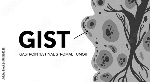 Gastrointestinal Stromal Tumor (GIST) Medical Illustration