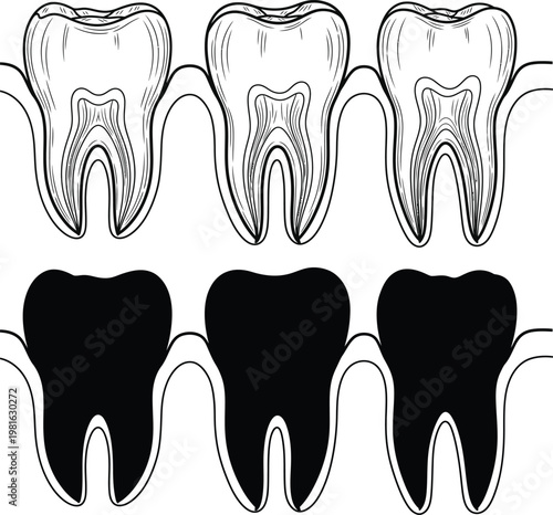Dental anatomy illustration three teeth with variations in cavity depiction