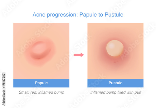 Acne progression from Papule to Pustule. Medical illustration compare the difference of acne types and show before and after steps. Dermatology education diagram.
