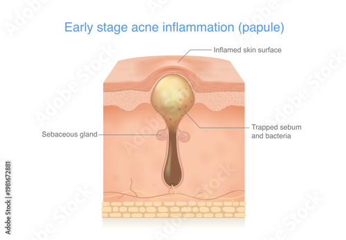 Skin layer anatomy of papule acne. Early stage acne inflammation. Clogged pore by trapped sebum and bacteria. Inflamed skin surface small red, swollen bump without visible pus.
