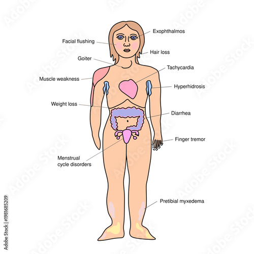 Symptoms of Graves’ Disease