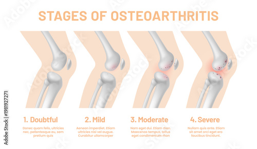 Medical infographics of knee joint osteoarthritis stages with human body leg bones and cartilages. Vector orthopedic chart with osteoarthritis stages from healthy to degenerative knee joints