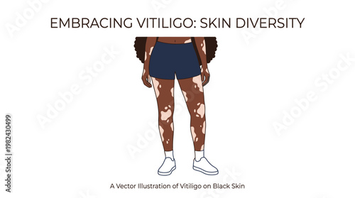 Vitiligo Skin Condition Black Woman Legs Medical Awareness Vector Illustration