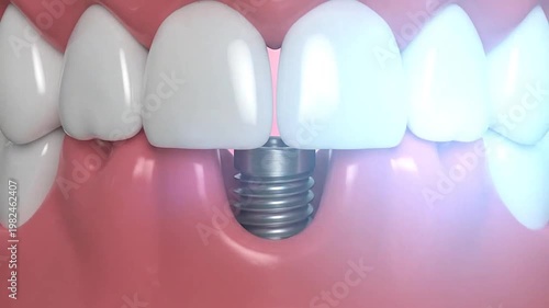 A detailed illustration of a dental implant, showcasing the artificial tooth and screw fixture