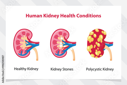 vector illustration of 3 kidney conditions. healthy kidney, kidney stones, polycystic kidney.
polycystic kidney disease illustration renal cysts.