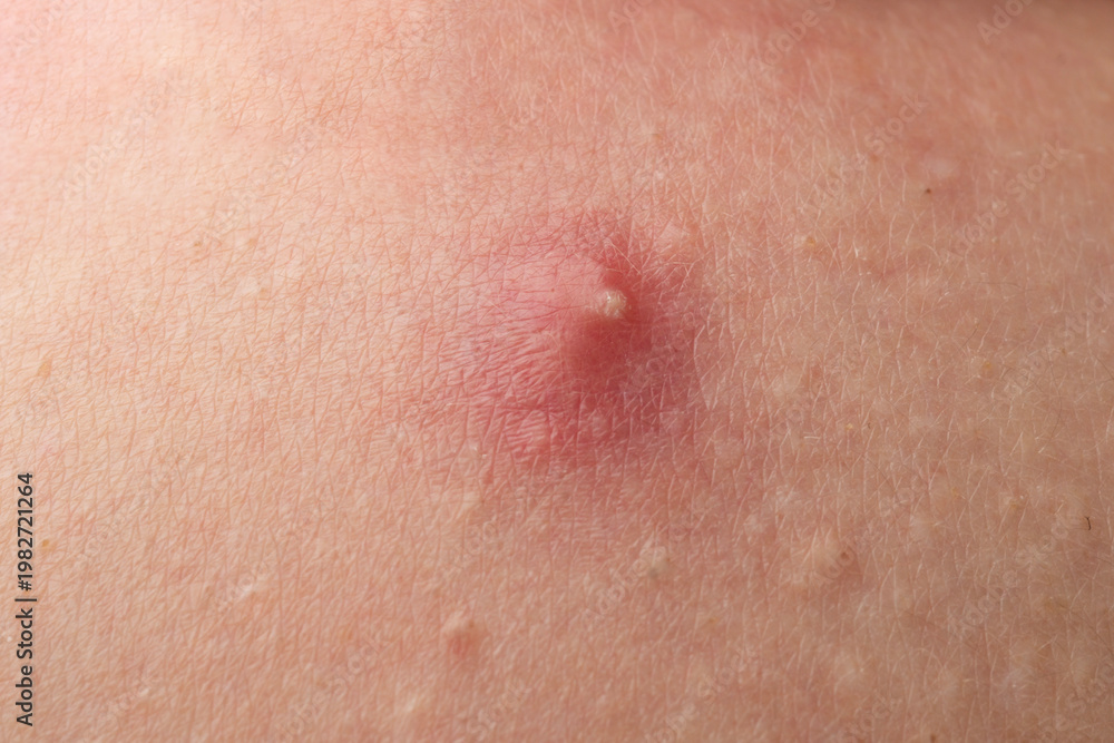 Fototapeta premium Skin inflammation with whiteheads and acne detail. Irritated skin with pimples acne texture. Acne on skin closeup photo. Detailed skin with acne.