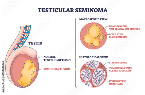 Testicular seminoma diagram explains cancer in the testis, showing a lobulated tumor mass and histology cells to clarify pathology and diagnosis. Outline diagram